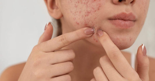 Quels sont les meilleurs remèdes naturels pour se débarrasser de l'acné? - La Boite à Grains